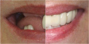 full mouth rehabilitation