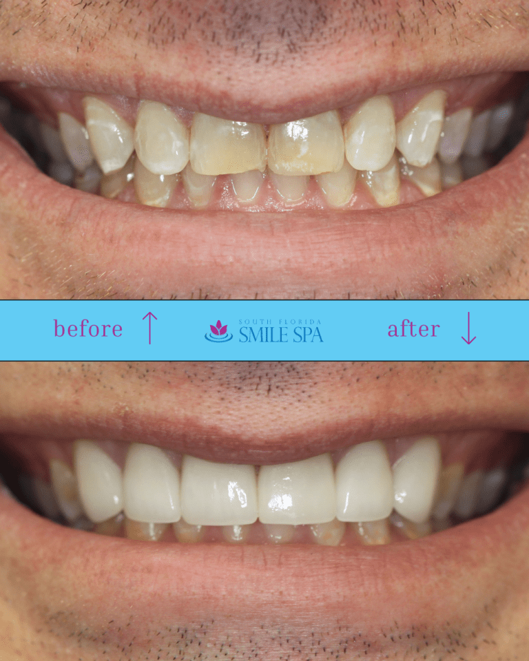 Smile makeover Pompano Beach before and after — porcelain veneers by Dr. Nicole Berger at South Florida Smile Spa