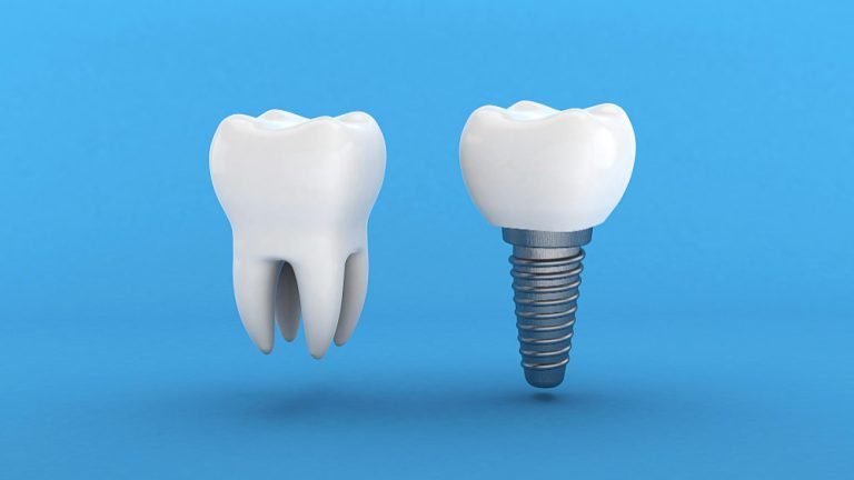 illustration of a tooth and a dental implant