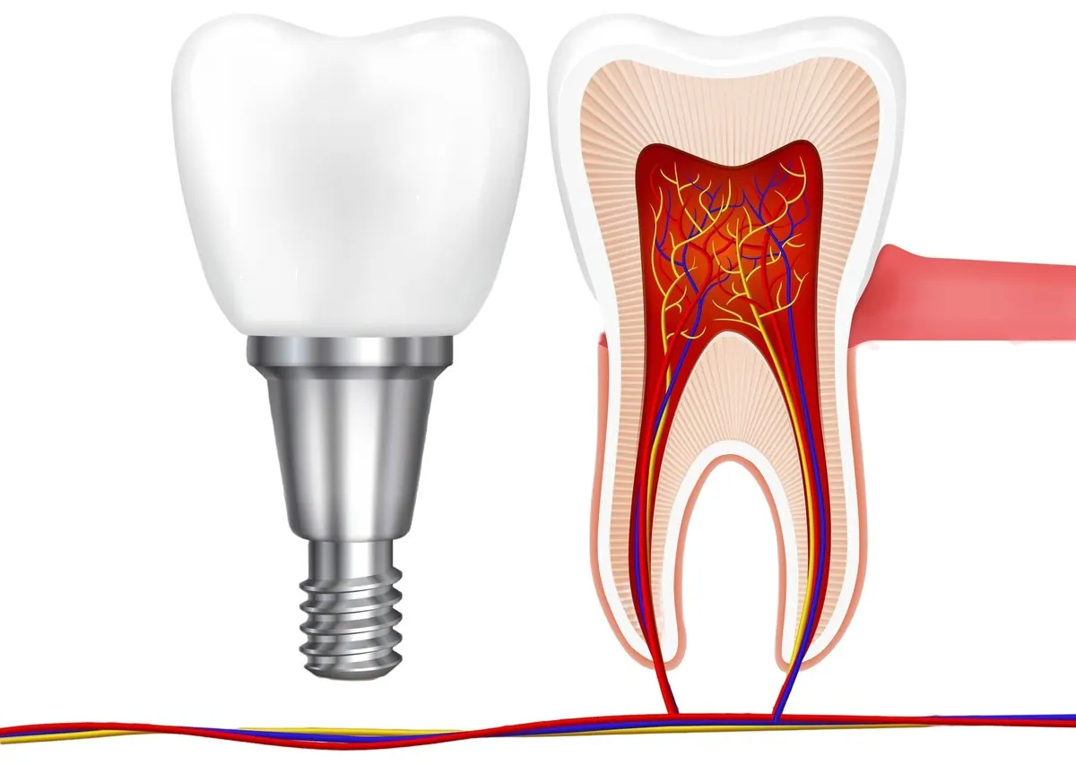 Cross-section illustration comparing a dental implant and a natural molar with its root canal system, showing the root canal vs dental implant decision.