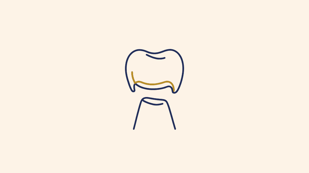 A diagram of a dental crown lifted off the prepared tooth underneath it, showing why a lost crown needs to be re-cemented promptly.