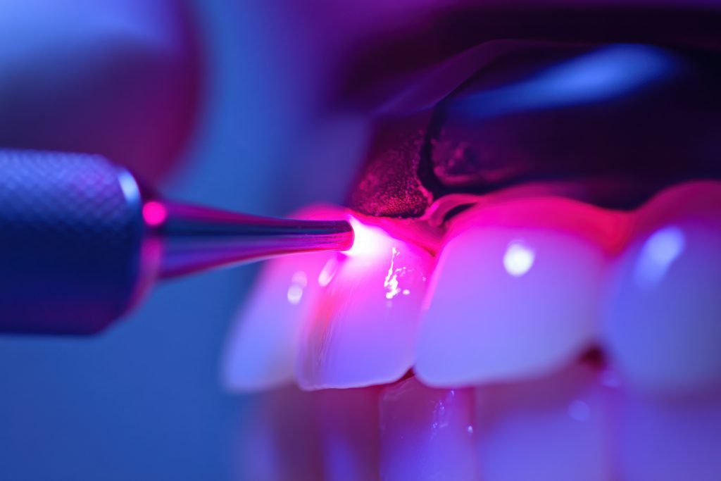 Close-up of a soft-tissue dental diode laser used for laser gum treatment