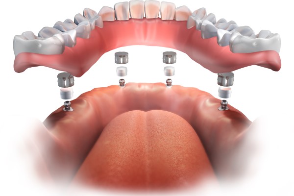 All On   Are Full Arch Fixed Implant Bridges