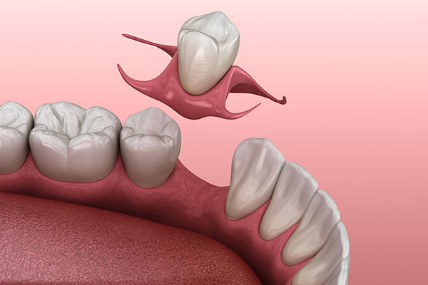Partial Denture for One Missing Tooth: Can It be a Removable Denture? from South Florida Smile Spa, Nicole M. Berger, DDS in Pompano Beach, FL