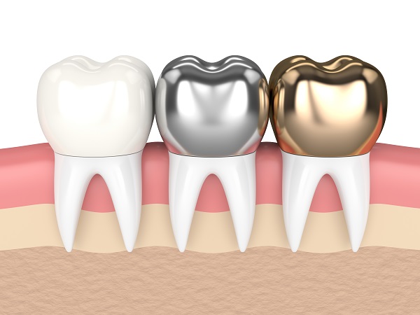 Ceramic Dental Crowns Or Other Dental Crown Materials?