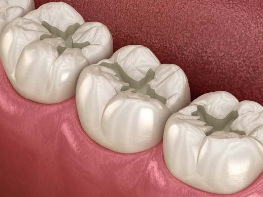 What To Expect When Getting Dental Fillings For Cavities