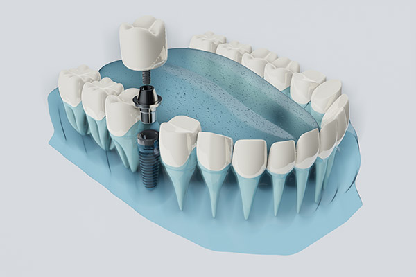 FAQs about Dental Implants from South Florida Smile Spa, Nicole M. Berger, DDS in Pompano Beach, FL