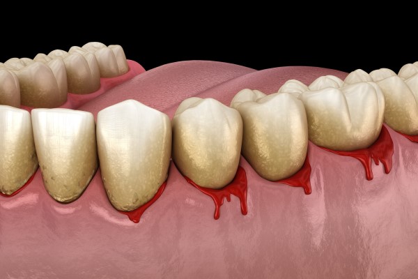 Proper Oral Hygiene Is Effective For Stopping Bleeding Gums