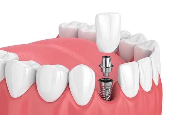 How Painful is Dental Implant Surgery from South Florida Smile Spa, Nicole M. Berger, DDS in Pompano Beach, FL