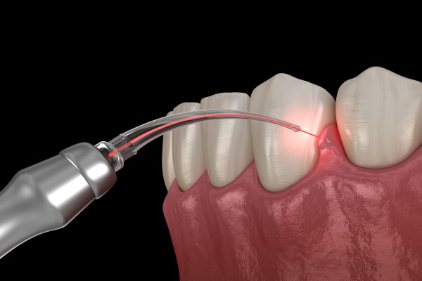 Four Things To Know About Laser Dentistry