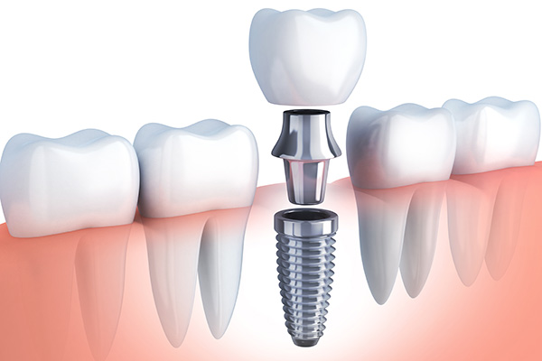 Questions to Ask Your Implant Dentist from South Florida Smile Spa, Nicole M. Berger, DDS in Pompano Beach, FL