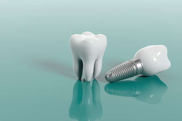 Multiple Teeth Replacement Options: One Implant for Two Teeth from South Florida Smile Spa, Nicole M. Berger, DDS in Pompano Beach, FL