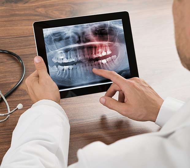 Pompano Beach Types of Dental Root Fractures
