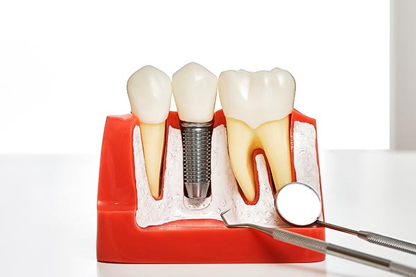 Your Guide to Different Kinds of Dental Implants from South Florida Smile Spa, Nicole M. Berger, DDS in Pompano Beach, FL